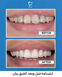 طويريج • تقويم اسنان • زراعة اسنان