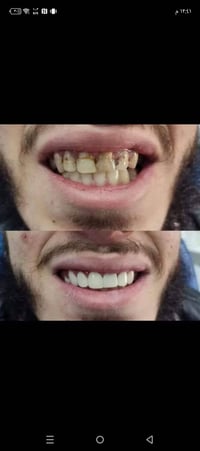 تركيب أسنان • ثابتة ومتحركة • متنقل