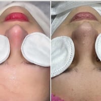 عروض عن تنضيف بشره العميق الملكي بجهاز الهايدروكول ويه حف الوجه ويا ما...