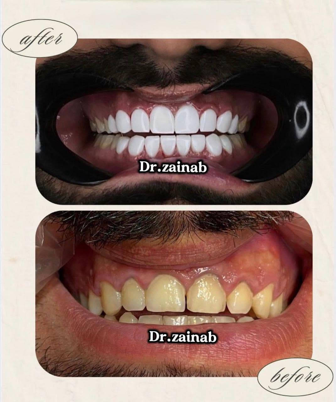✨ ابتسامتك تبدأ من هنا ✨

في عيادة الدكتورة سمر أمير لطب وتجميل الأسنان نهتم بصحة أسنانك وجمال ابتسامتك بأحدث التقنيات وعلى أيدي أطباء ذوي خبرة.

🦷 خدماتنا تشمل:
✅ تنظيف وتلميع الأسنان
✅ تبييض الأسنان
✅ الحشوات التجميلية
✅ سحب العصب
✅ تركيبات الأسنان
✅ زراعة الأسنان
✅ هوليوود سمايل
✅ تقويم الأسنان

📍 العنوان: بغداد – مواصلات – شارع الضغط – فوق صيدلية قمر بغداد

📞 للحجز والاستفسار:
***********
***********

🌟 احجز موعدك اليوم... لأن الابتسامة الجميلة تستحق أفضل عناية.
