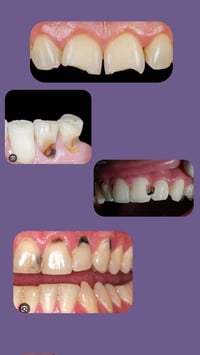 يتوفر علاج بحشوة ضوئية للحالات الاتية العلاج مجاني و بأشراف اطباء مُخت...