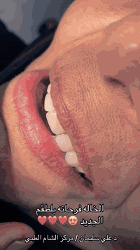 حالة لامرأة كبيرة بالعمر أجرينا لها طقم أسنان علوي متحرك ، أجمل لحظة هي فرحتها بعد التركيب ✨🥰❤️

📞 للاستفسار والحجز:
***********
📍 العنوان:
واسط – قضاء الحي – مركز الشام الطبي
🕒 ساعات العمل:
من 3 مساءً إلى 10 مساء

عيادة_اسنان #مركز_الشام_الطبي #واسـط #قضاء_الحي
#طقم_اسنان #تعويضات_اسنان #ابتسامة #صحة_الفم
#طقم_علوي #دكتورة_اسنان #ابتسامة_جميلة
#اسنان_العراق #ابتسامة_ثقة #عناية_اسنان
