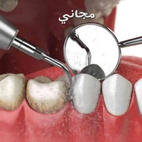 كلية طب الاسنان كركوك • تنظيف اسنان • علاج مجاني