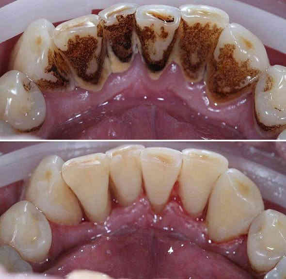 تنظيف اسنان  ازالة التكلسات و التصبغات التي تضر اللثة و الاسنان 
ـ العلاج مجاني ـ
احجز موعدك الان لابتسامة جميلة و صحية 🤍
للحجز والاستفسار راسلونا على الخاص 
واتساب : ***********

العنوان : كربلاء ـ الحر الصغير 
#كربلاء #مجاني #علاج_اسنان_مجاني #علاج_اسنان #دكتوراسنان
