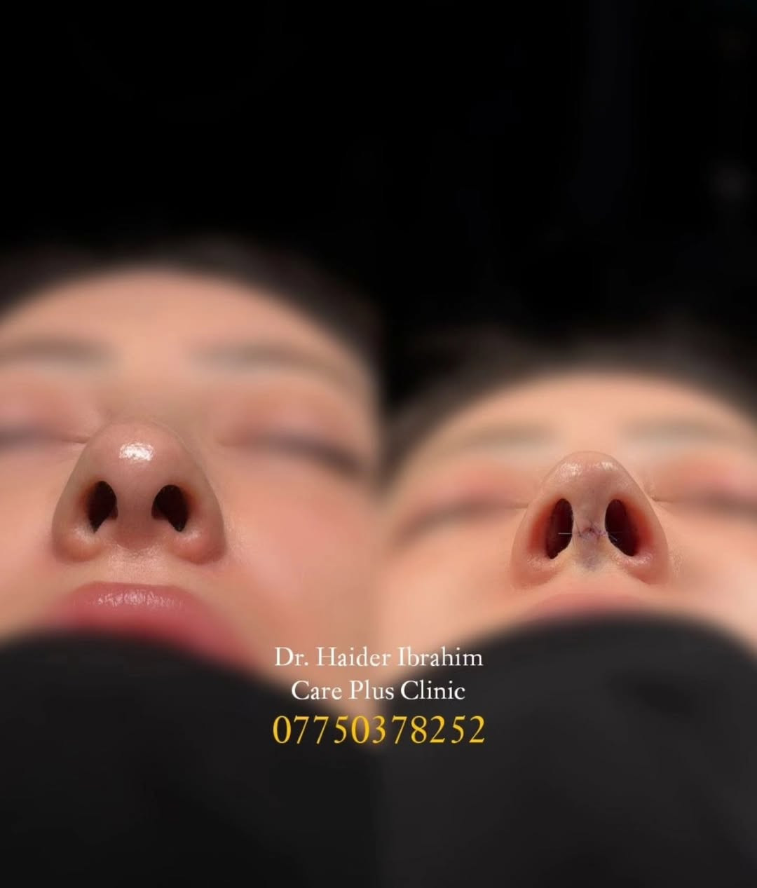 ✨ تجميل أنف أنثوي برسمة متناسقة تناسب ملامح الوجه ✨

نتائج طبيعية ولمسة جمالية تحافظ على تناسق الوجه، مع تصميم يناسب ملامح كل حالة بشكل فردي للحصول على مظهر أنثوي ناعم وجذاب.

👨‍⚕️ الدكتور حيدر إبراهيم 📍 متواجد يوميًا لاستقبال المعاينات والحجوزات. 📞 ***********

#تجميل_الأنف #رأب_الأنف #أنف_أنثوي #تجميل #نتائج_طبيعية جراحة_تجميل الدكتور_حيدر_إبراهيم بغداد العراق
