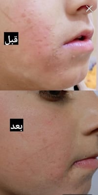 علاج الثالول • مضمون • خلال أسبوع