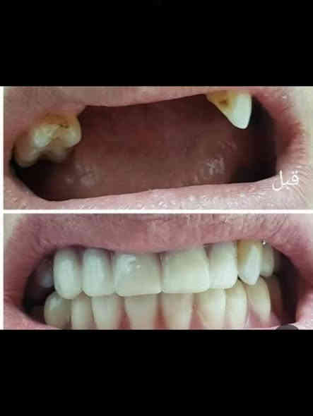 السلام عليكم اللي محتاج علاج مجاني  تنظيف قلع حشوة ضوئية طقم متحرك يتواصل واتساب ***********
بغداد الدورة نهاية شارع ستين قرب كنيسة بولص وبطرس جامعة الهادي
