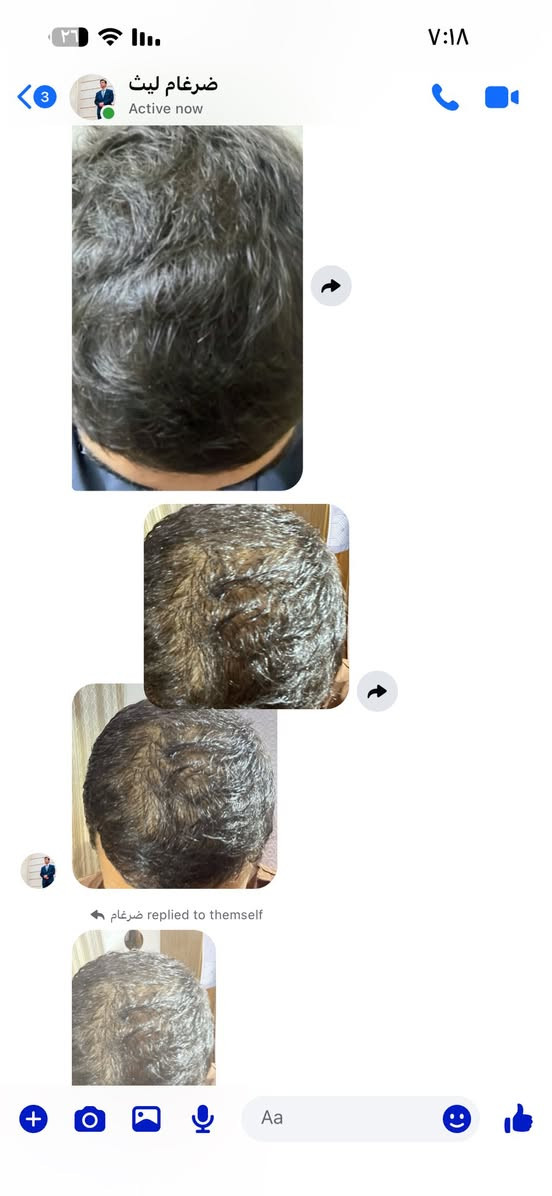 🪂عفيه ليش محد يرفعلي منشوري حسبوهي لوجه الله ورفعو المنشور حتى لو بحرف  والله عائله بركبتي هذا باب رزقي
ولله العضيم اطيجن زيت للرجال وللنساء  اذا ماطول وقف الساقط وثخن شعررج وحق العباس  فلوسج تررجع زيت بل عشاب يجنن وريحته  تخبل اخمره مده سبوع يلا ابيعه ينطي مفعول اكثر 
تدعلي واني حلفت بعد
 هاي نتيجه شعري ونبي يجنننن واني من احلف حته اخلي اهل البيت كبال عيني وتغررني الفلوس وغش العالم وماكل حق غيري للستفار خاص او 
***********
