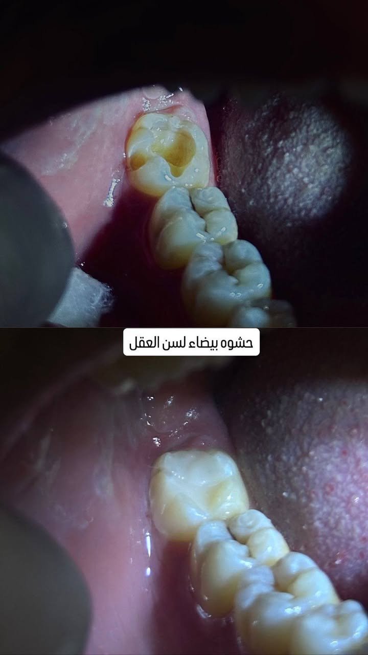 إذا تبحث عن العناية بأسنانك بأيدي خبير، زور عيادة الدكتور هاشم غسان.
✅ فحص وتشخيص دقيق

✅ علاج وحشوات الأسنان

✅ تنظيف وتلميع الأسنان

✅ سحب الأسنان

✅ تركيبات وتجميل الأسنان

نهتم براحتكم ونحرص على تقديم أفضل رعاية بابتسامة وثقة.

📍 العنوان: موجاور دكتوره حنين نجم جبوري)

📞 للحجز والاستفسار: (***********)

الدكتور هاشم غسان – لأن ابتسامتك تستحق الأفضل.
