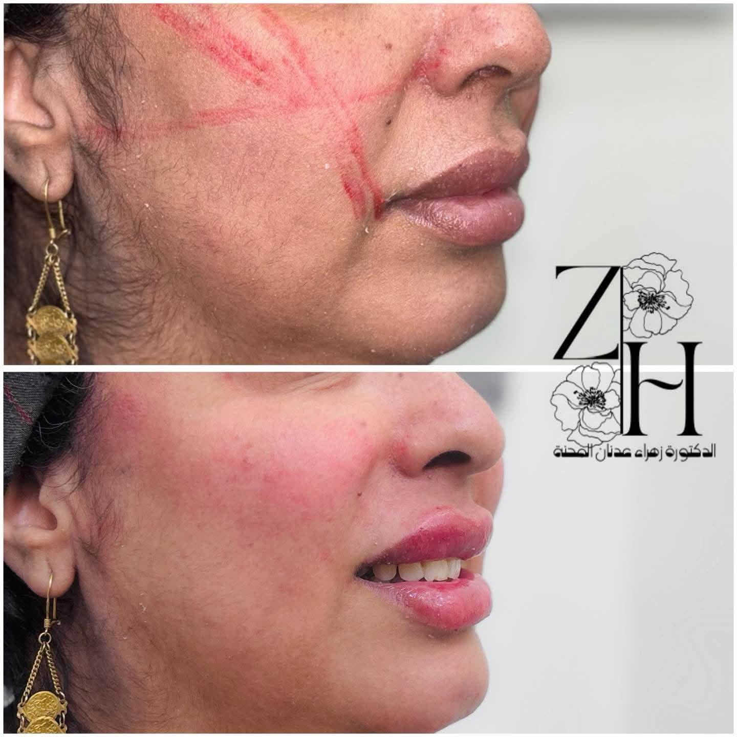 عروض عيادة الدكتورة زهراء عدنان المحنة✨💕

فلر عشرة سيسي + 
بوتكس
+ نضاره✨🤭
وتنظيف بشرة هدية✨✨✨🦋

كل هالجمال ب٣٠٠ الف فقط
وتدللون ياحلوات ✨✨

(العروبة داخل فرع مثلجات حسين وسنتر دولار)

للحجز والاستفسار التواصل على الخاص او الاتصال على الرقم التالي

📞***********
