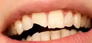 📌 إعلان من عيادات طب الأسنان 📢

يسر عيادات طب الأسنان في كربلاء المقدسة أن تعلن عن استقبال المراجعين مجانا بإشراف كادر تدريسي ومتخصص من أطباء الأسنان.

🦷🩺والخدمات المجانية تشمل:

✨فحص وتشخيص الأسنان واللثة

✨الحشوات التجميلية الضوئية

✨تنظيف الأسنان وإزالة الجير والترسبات

✨قلع الأسنان والجذور والأسنان التالفة

✨عمل التركيبات السنية الأطقم والجسور

📌 الموقع كربلاء المقدسة - شارع الحر - عيادات جامعة اهل البيت

🕣 أوقات المراجعة من الساعة 8:30 صباحاً حتى 1:00 ظهراً خلال أيام الدوام الرسمي

📞📱للتنسيق والحجز • عبر الاتصال أو الواتساب على الرقم ***********

https://wa.me/9647830340502?text=سلام%20عليكم%20دكتور...%20اريد%20احجز
