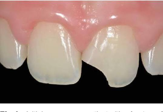 السلام عليكم اي شخص عندة اسنان امامية مكسورة نسويلة حشوة تجميلية بلون السن ، النقل مجانا + 25
*********** واتساب

