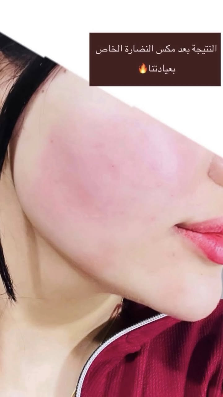 عيادة التجميل الاولى في الحسينية وتحت إشراف أطباء مختصين وبأنسب أسعار عنوان العيادة الجريخي مجمع الصدرين الطبي الطابق الثاني مقابل مطعم جكن اوسلو 
عيادة اوليفيا للتجميل 
للحجز والاستفسار واتساب ***********
