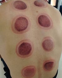 دم الحجامة • معادن ثقيلة • كريات دم هرمة