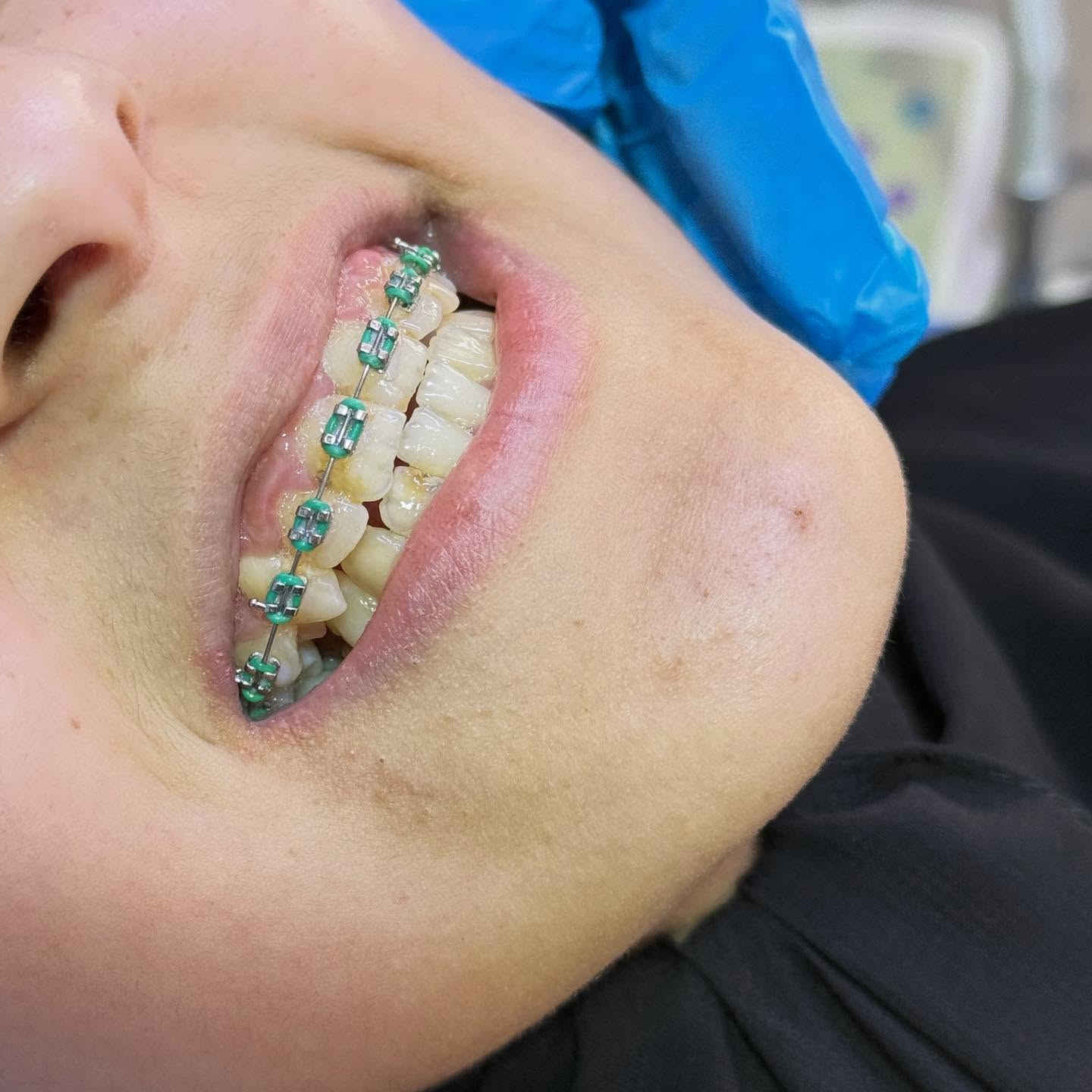 ⁨ حالة اخرى من شغل الدكتورة بتول عمار المرمضي  ‪@bt.dent369‬ 📍📍عيادة بيرلي (نبتون)
الحمزة الشرقي جهة شارع الملاحة مقابيل صيدلية نجلاء الشيباني 
واتساب او الاستفسار ***********  #اكسبلور #فولو #اكسبلور_explore #فولورزي #فان #بيرلي #الحمزة_الشرقي #2026 #اكسبلور_العراق_السعوديه_الاردن_ايران_الكويت_طق_لايكات_كومنت_يلاا💙⁩
