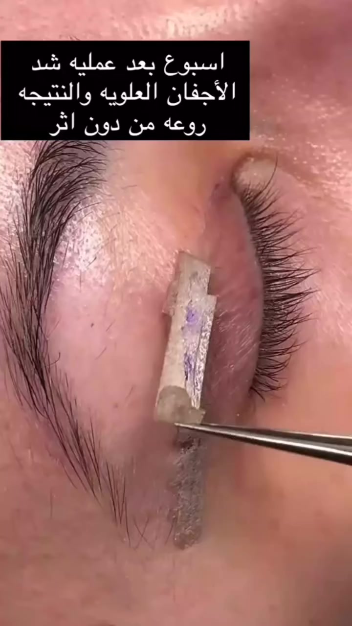 ✨🌙 عروض رمضان – عيادة الشهد للتجميل 🌙✨

بمناسبة شهر الخير، خصومات خاصة لفترة محدودة ✨

🔹 العمليات الجراحية:
▪ قص الأجفان العليا – 250
▪ قص الأجفان السفلى – 350
▪ تصغير فتحات الأنف – 350
▪ شد وجنات جراحي – 400
▪ رفع الحاجب جراحي – 350
▪ سحب العين – 300
▪ عين القطة – 350

💉 الفيلر:
▪ فلر شفة فرنسي – 75
▪ فلر شفة إيطالي – 90
▪ فلر شفة سويسري – 125

🌟 تغيير شامل – 350

📍 العناوين:
الفرع الأول: بغداد – شارع فلسطين
الفرع الثاني: بغداد – بسماية – الشارع العام

📞 للحجز والاستفسار:
***********

رمضان فرصة للتجدد ✨ إطلالة جديدة وثقة أكبر بانتظاركم �
