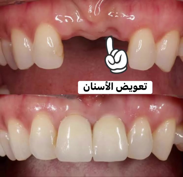 تعويض الأسنان بطقم متحرك.
*********** جامعة كربلاء - حي الموظفين- قرب مستشفى الولادة
