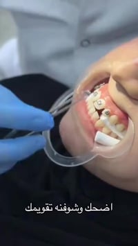 تقويم أسنان • بالتقسيط • بدون كفيل