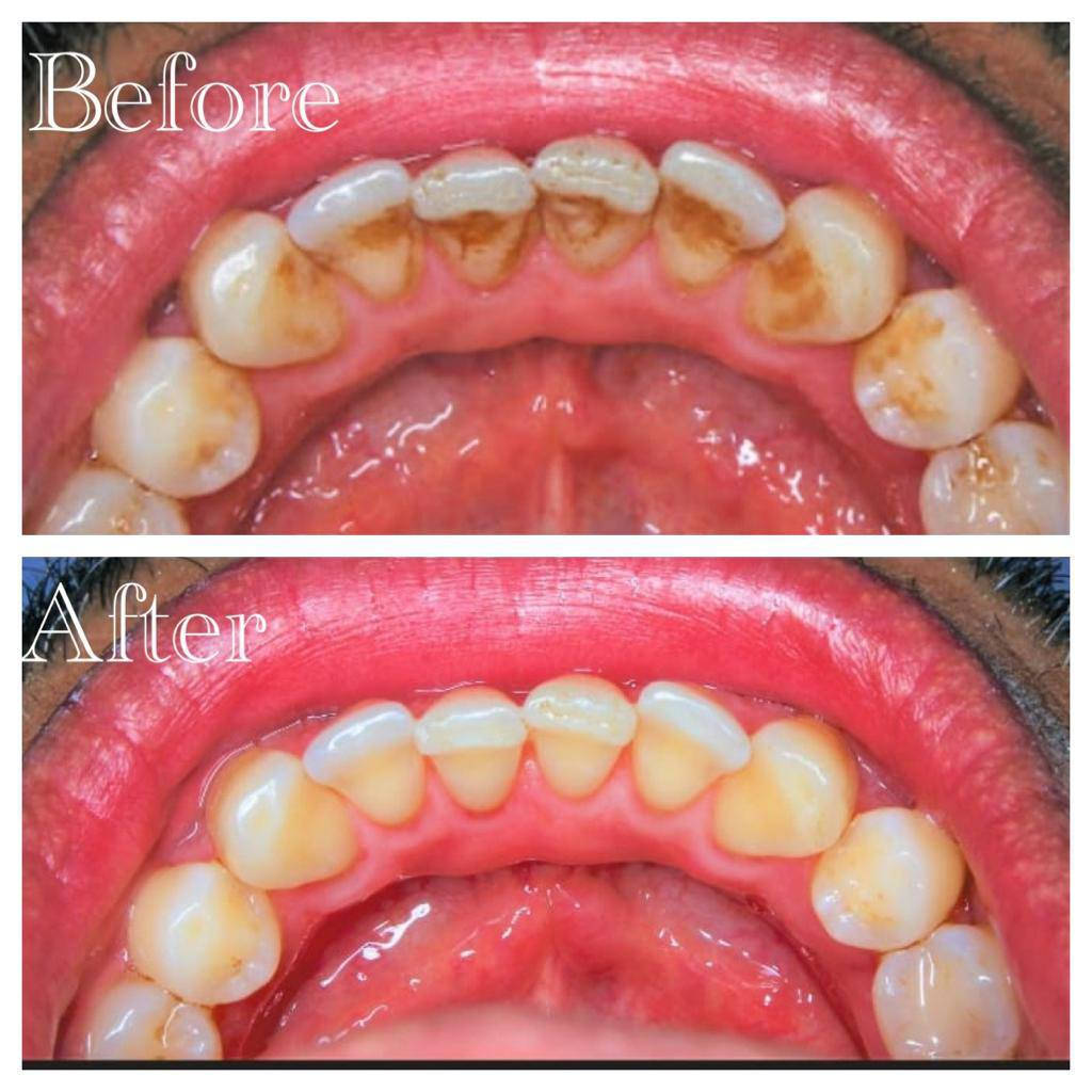 ✨العلاج مجاني 🦷
فحص الاسنان_حشوات ضوئية _تنظيف الاسنان_قلع الاسنان
📍 بغداد _القادسية_جامعة ابن سينا للعلوم الطبية _ مقابل بلدية الرشيد

للحجز:***********
