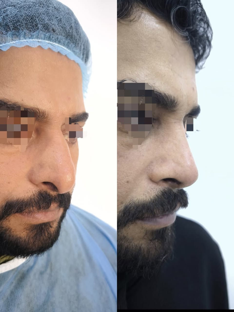 ✨ وداعاً للانحراف.. واستمتع بجمال التماثل الطبيعي! ✨
​هل تعاني من ميلان واضح في جسر الأنف أو تشوه ناتج عن كسر سابق؟ الحل الآن أصبح أسهل وأقرب إليك مما تتخيل!
​الحالة المعروضة في الصور:
​قبل العملية (الجهة اليمنى): يظهر بوضوح ميلان وانحراف في محور الأنف ناتج عن كسر سابق، مما أثر على تناسق ملامح الوجه.
​بعد العملية (الجهة اليسرى): استقامة تامة وشاقولية لمحور الأنف، مع رسمة طبيعية تتناسب تماماً مع تقاسيم الوجه.
​لماذا تختار عيادتنا؟
​نحن نحول التحديات الجمالية والوظيفية إلى نتائج واقعية ومثالية:
✅ تعديل الانحراف والكسور بدقة متناهية.
✅ تخدير موضعي (بدون الحاجة للتخدير العام ومخاطره).
✅ إجراء آمن وسريع وبأحدث التقنيات الجراحية.
​💰 عرض خاص لفترة محدودة:
​احصل على الأنف المثالي الذي طالما حلمت به فقط بـ 600,000 دينار عراقي! 🇮🇶
​📍 العنوان: [الشطرة ـ حي المعلمين ـ مركز ااشرق الأوسط]
📞 للحجز والاستفسار: [‏078-132-88144‏
​نحن نرسم الجمال.. لنعيد إليك الثقة!
​#تجميل_الأنف #تعديل_انحراف_الأنف #تجميل #عراق #بغداد #تخدير_موضعي #جمال #ثقة #عمليات_تجميل #قبل_وبعد
