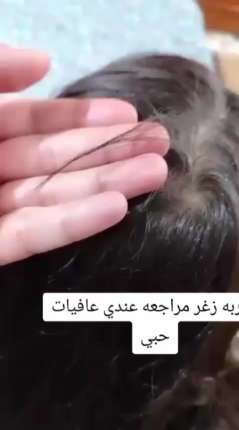 بخاخ الشعر   بديل زراعة الشعر  يعني بعد اليوم متحتاجون زراعة شعر لان البخاخ هاذ يملى الفراغات ويثخن الشعر بمدة اقل من 4 اسابيع تبدي فراغات الشعر نبت بصيلات شعر صغيرة و وبمرور الوقت تكدرون تلاحضون الفراغات بدت تنترس شعيرات صغيرة وهيج يثخن شعر ويطول 
الحل المثالي الجذري للشعر خصلنة من معانات شعري خفيف وشعري قصير وشعري يوكع ماكو بعد والتجارب كدامكم 👇🏻
و الله العظيم الفرق يبين من اول 3 اسابيع


**إذا كنت صاحب هذا الإعلان وتريد حذفه لأي سبب، رجاءا أرسل رسالة إلى الدعم الفني**