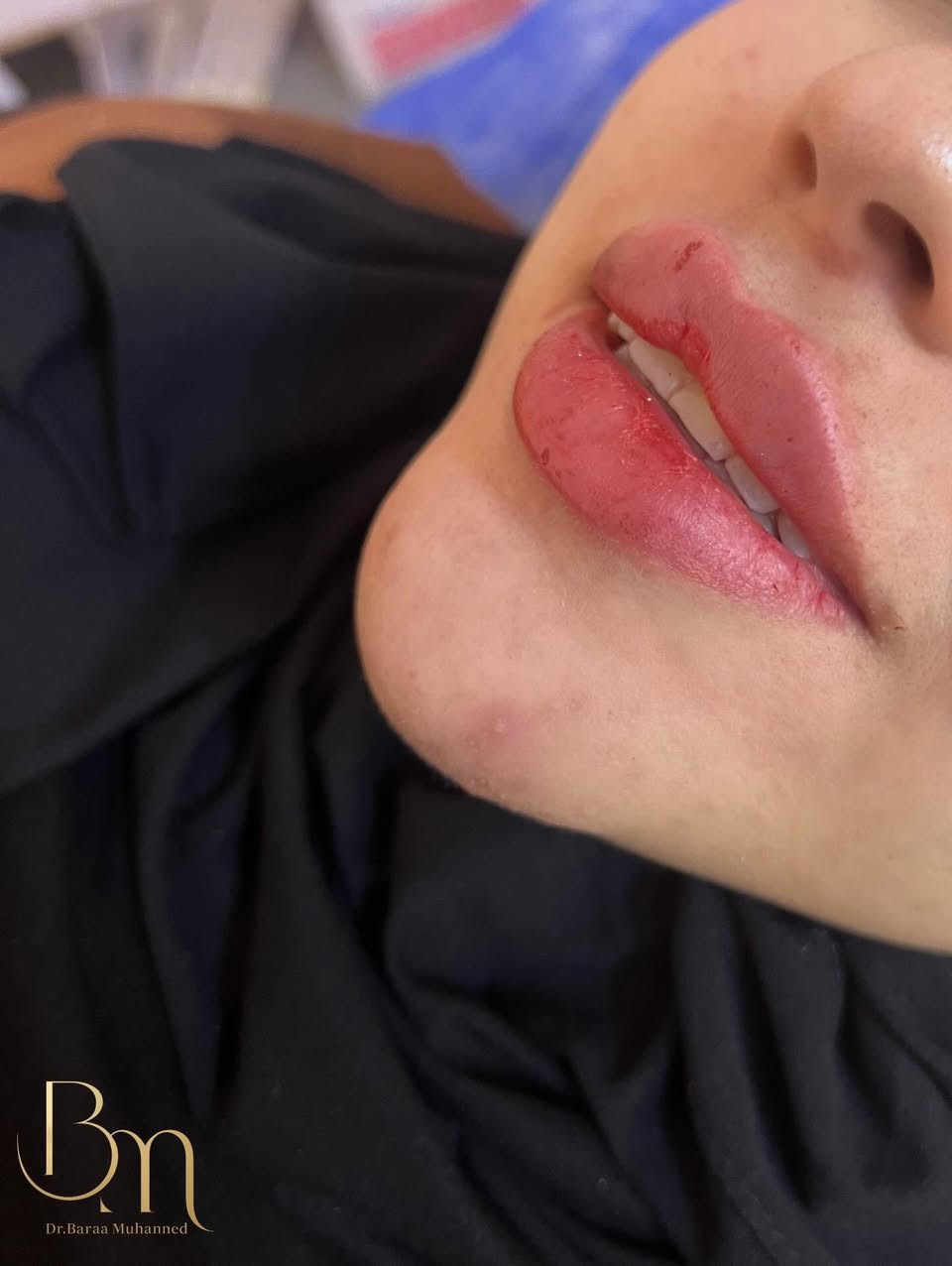 عيادة التجميل الاولى في الحسينية وتحت إشراف أطباء مختصين استغلوا آخر ايام لعروض العيد متواجدين طيلة ايام العيد للحجز السريع واتساب ***********
