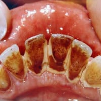 علاج اسنان مجاني • الجامعة العراقية الأعظمية • حشوات قلع تنظيف