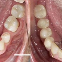 علاج مجاناً مجاناً اللي عنده فقدان بالأسنان خلفية نعوضهم باسنان صناعية...
