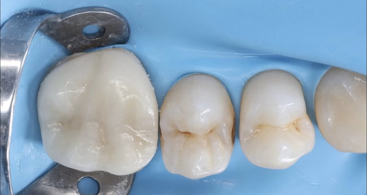 اهلنا الطيبين 🌸

..…ابتسامتكَ هي ثقتنا 🤍 ……

متواجدين طيلة ايام الاسبوع
........................................................................
 

من الساعة ٢ ونص وحتى ال 9 مساء ♥️

عيادة الطائي في منطقة سبع البور 💯

العنوان 📍: سبع البور منطقة الـ 4000 عمارة الجوادين

بادارة الدكتور : حارث الطائي & ارين القصاب 🚨

علماً انهُ : المعاينة و الفحص مجاناً 🚨🚨🚨🚨
                                الاشعة مجاناً 🚨🚨🚨🚨

تختص العيادة : حشوات التجميلية  - حشوات الجذور - القلع والقلع الجراحي - تراكيب السيراميك والزاركون - قشور الايماكس (ابتسامة المشاهير ) 🦷🪥
يوجد ايضاً : تنظيف وتبيض الاسنان 😀
زراعة الاسنان - تقويم الاسنان 💯
             
                               الفحص مجاناً 🚨🚨🚨🚨
                                الاشعة مجاناً 🚨🚨🚨🚨

*وداعاً للباص واسعار الاشعة المبالغة بها 💯*

عيادة الطائي ابتسامتك المتميزة تبدأ من هنا 😀

للحجز والاستفسار : ***********

عيادة الطائي لطب الاسنان

#سبعالبور #التاجيات #التاجي #سبع_البور
