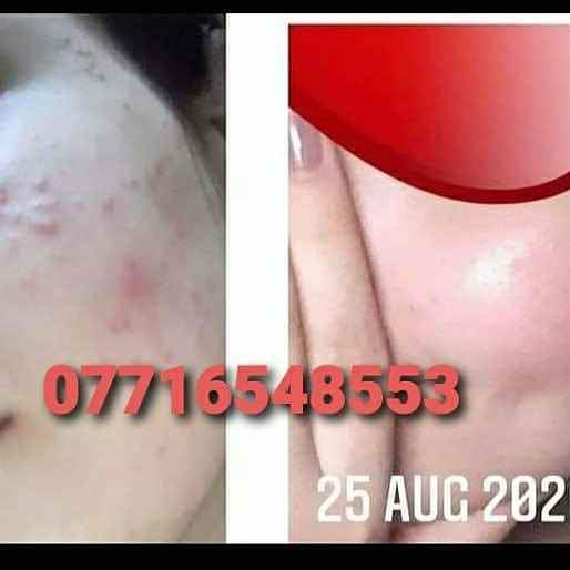 خلطه وصابونه 
شرط الشغل بلعباس  مجربه ومضمونه خلال 3 ايام تبين النتيجه وحق العباس 
عندك سمار تبيض الوجه تصفيه من الحب والكلف والنمش والتصبغات والسواد الجوه العين 
اثار حبوب اثار الشمس أخذي وخطيتج بركبتي شغله رهيييييييييييييييييب
والي مجربيها قبل يعرفون معنى كلامي المنتج الاول لعلاج وإزالة الكلف والبقع 
تعالج الكلف والبقع وترطب البشره وينطيها نضاره وبنفس الوقت تفتيح وتبييض  للبشره للاستفسار وات ساب 
 ***********
*********** عمارة, ميسان
