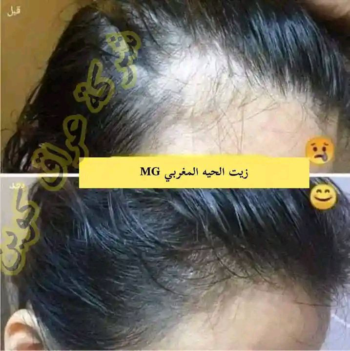 الي يعانون من تساقط الشعر والي شعرهن مايطول ابد 🥲     

  توفر زيت الحيه الصحراوي الاصلي 100%  يعني تطويل وتنعيم وتوقف ملحوظ بتساقط الشعر 💇🏻‍♀️💛 والتجارب خير دليل على فعاليه المنتج * يمكن استخدامه من من قبل النساء والرجال توقف التساقط باول استعمالين او 3

 للحجز والاستفسار خاص💛


**إذا كنت صاحب هذا الإعلان وتريد حذفه لأي سبب، رجاءا أرسل رسالة إلى الدعم الفني**