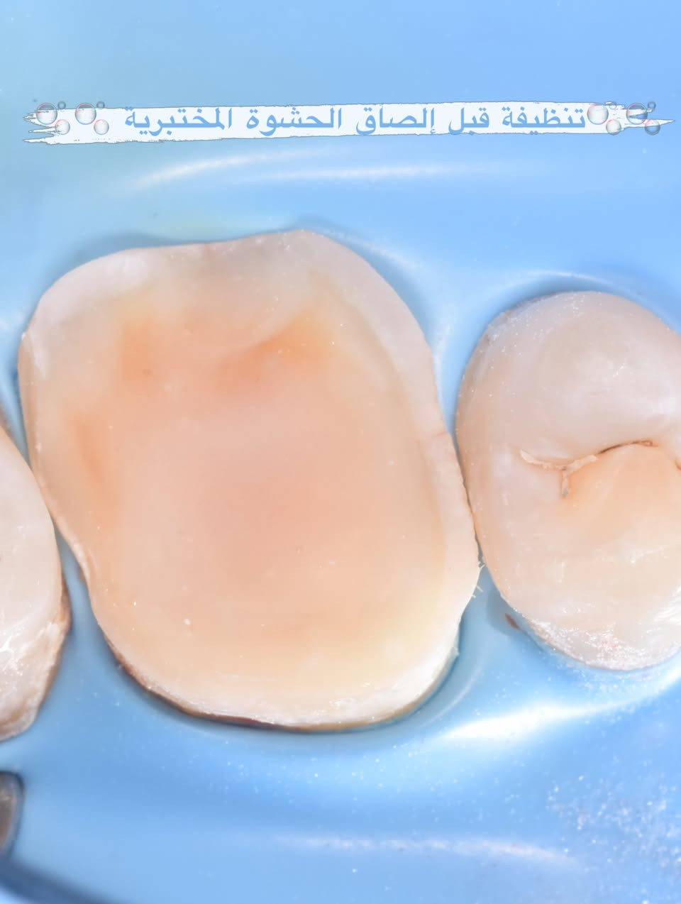 حشوة مختبرية 🦷🪄🫧🌸
.
.
.
.
#حشوة_مختبرية #حشوة_ضوئية #ابتسامتك_أجمل #ابتسامة_طبيعية #صحةالأسنان


**إذا كنت صاحب هذا الإعلان وتريد حذفه لأي سبب، رجاءا أرسل رسالة إلى الدعم الفني**