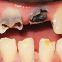 الي عنده أسنان تالفه أو أسنان عقل ويريد يقلعهم يتواصل ويايه على الخاص ...