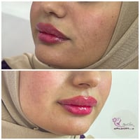 فيلر شفة • مجمع علم الكندي • إزالة تاتو