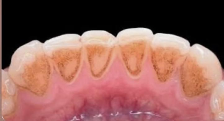 السلام عليكم
الي عنده بقايا جذور اسنان او اسنان تالفة محتاجة قلع

او تنظيف اسنان او حشوات ضوئية تجميلية 

مثل الحالات الي بالصوره 

يكدر يتواصل وياي على الواتساب ***********

 ونحدد موعد الشغل 

العنوان الحلة شارع اربعين مجاور صيدلية سلامتك اولاً
