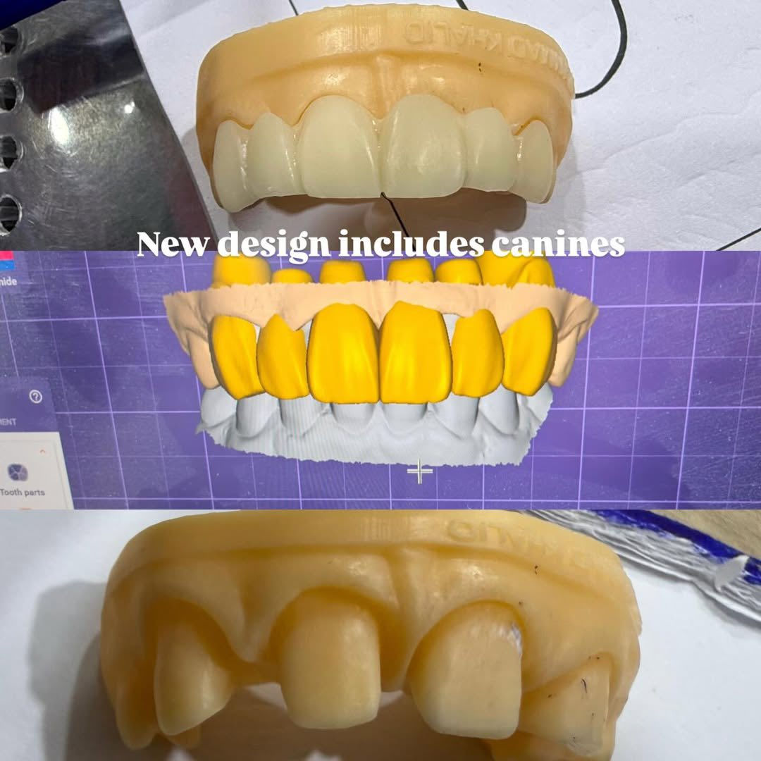 ✨ ابتسامة جديدة… ثقة أكبر ✨

من أول جلسة تگدر تشوف الفرق 👌

تركيب تجميلي يغيّر شكل الابتسامة ويعطي مظهر طبيعي وناصع 🤍

📸 الصورة تحچي عن نفسها – قبل وبعد

📍 عيادة لؤلؤة بدرة

📞 للحجز والاستفسار: ***********

ابتسامتك مسؤوليتنا 🌸

لا تتردد… خلّي ابتسامتك تحچي عنك �
