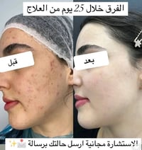 بديل الفلر • بدون إبر • يقلل التجاعيد