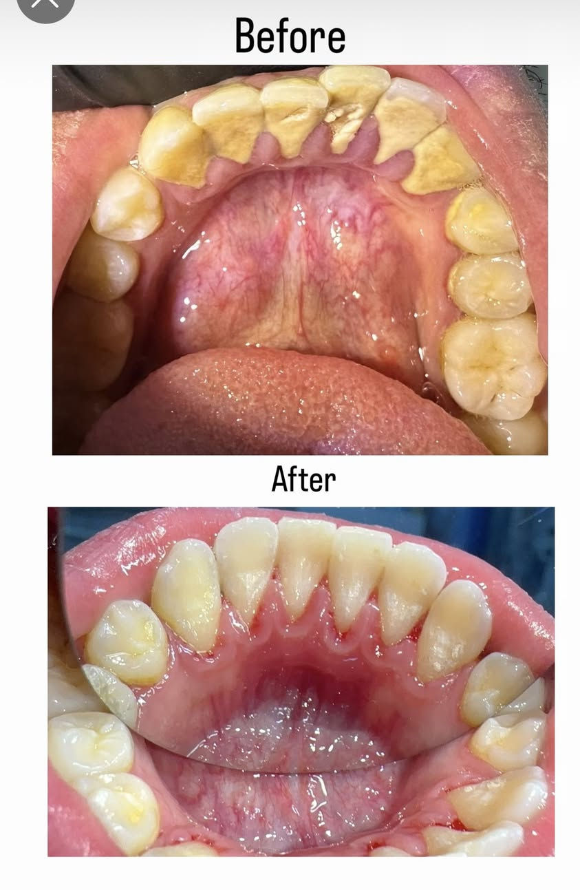 السلام عليكم  
🦷‼️
الدكتور عبدالله قاسم 
استقبل هاي الحالات :-
قلع الاسنان والجذور التالفه 
وتعويض الاسنان المفقودة بطقم جزئي
حشوات تجميلية للاسنان 
وتنظيف الاسنان وازالة التكلسات والتصبغات 
 
‼️علماً العلاج مجاني وباشراف اطباء اختصاص‼️

📍العنوان:- الكرادة_شارع 52_عيادات جامعة اوروك

  *********** 📞واتساب
