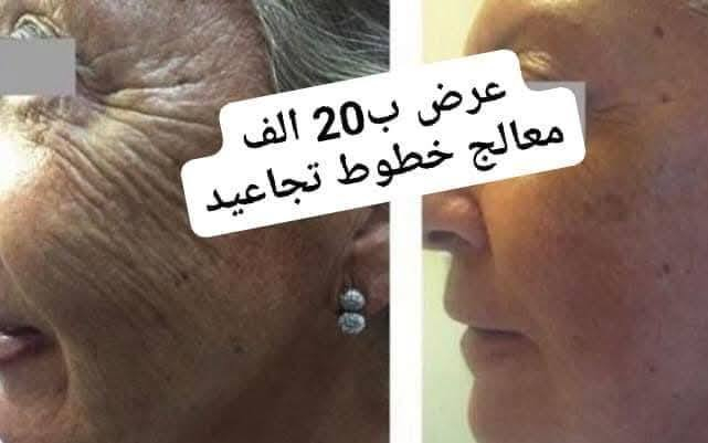 عرض ب 20  الف فقط
معالج تجاعيددد😍🤞

عرض جديد وحصري
كمية محدودة 😍🤞

والله لتجربة متخسر🤞😍


**إذا كنت صاحب هذا الإعلان وتريد حذفه لأي سبب، رجاءا أرسل رسالة إلى الدعم الفني**