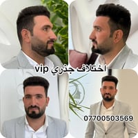 Vip اختلاف جذري عزيزي  زراعة الشعر إجراء طبي دقيق. نجاحه يعتمد على:  •...