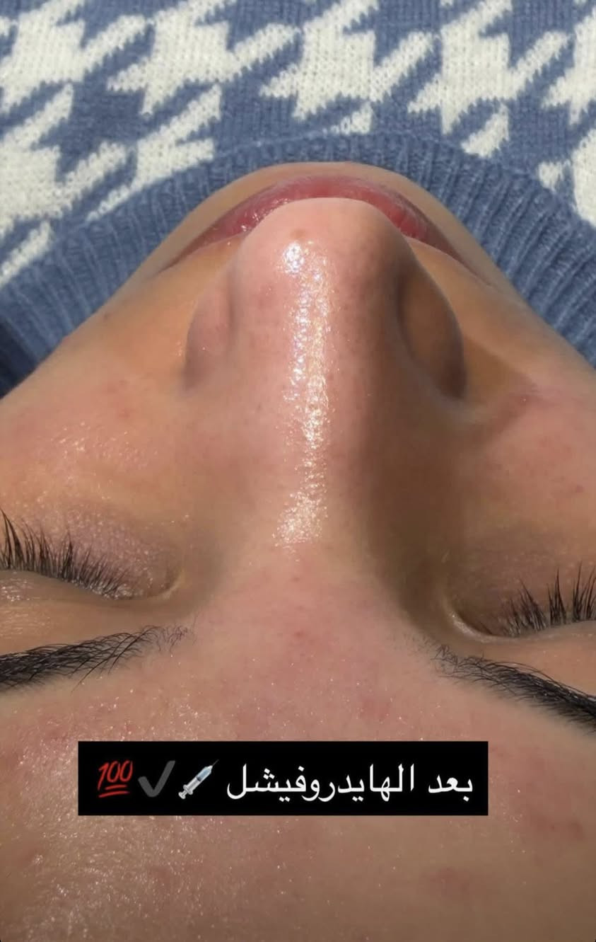 عروض البشره مستمره مع صالون واو بيوتي 

تنظيف بشره بجهاز الهايدروبيوتي بسعر ١٥ الف فقط 

تنظيف بشره عميق مع ابره نظاره بسعر ٢٥ الف فقط 

العنوان الحريه تقاطع مصور عيسى مجاور مجمع اطلس


**إذا كنت صاحب هذا الإعلان وتريد حذفه لأي سبب، رجاءا أرسل رسالة إلى الدعم الفني**