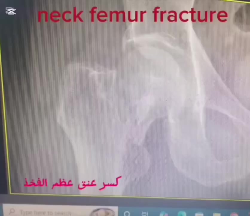 🔴 يوم الاربعاء عصرا يتواجد الدكتور حسن محي الدين رشيد 

                         دكتوراه أخصائي امراض وجراحة العظام والكسور والتهاب المفاصل وتبديل المفاصل والروماتيزم والاصابات الرياضية

‏‎ العمليات التي يجريها الطبيب:
✅علاج انزلاق الفقرات
✅ العمليات الناظورية والمجهرية للعمود الفقري بتداخل محدود
✅عمليات تبديل المفاصل 
✅ عمليات الأصابات الرياضية
✅جراحة العظام والكسور
                                    
 🟢 للحجز والاستفسار  :*********** - ***********

🟢العنوان / مجمع الثقة الطبي طوزخورماتو / شارعة الصاغة / قرب مدرسة يافا الابتدائية
