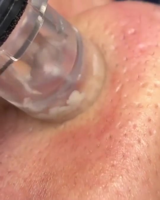 جلسة تنظيف بشره (هيدرافيشيل) في أيقونة 🦋
من فوائد #هيدرافيشل للوجه👌🏻
بجانب الهدف الرئيسي المتمثل في تنظيف البشرة وإزالة الأوساخ المتراكمة فيها ومنحها مظهراً جذاباً نابضاً بالحياة،
 من فوائد الفيشل للوجه لبعض الحالات التي تعاني من مشاكل جلدية✨
_ تنظيف البشرة السطحى والعميق🧼
_ تقشير البشرة💆🏻✨
_ شد البشرة وتفتيح وتقليل المسام وازالة الترهلات من الوجه

متوفر يومـيا 🤍🫣
هيدرافيشل ١٠الاف🫣
✨____________________✨

الحجز واستفسار على ارقام 👇🏻
***********
العنوان المحموديه....مجمع المصطفى ....اسواق المصطفى 💗

