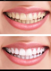 تعلن عيادةجوري لطب وتجميل الاسنان عن توفر عروض لتبيض الاسنان بالليزر و...