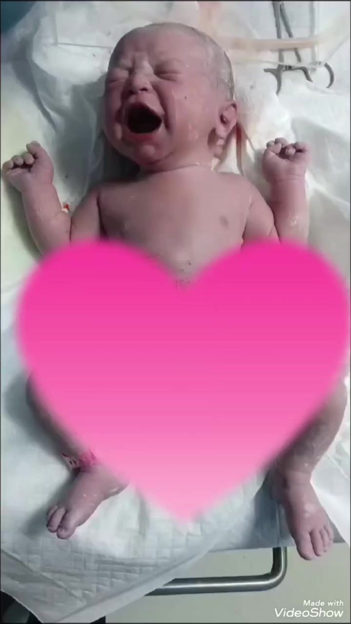 راجعتنا المريضة (ز.ع) عدها ثلاث عمليات قيصرية سابقة ومبلغيها بخطورة الحمل عليها وعالرحم لوجود التصاقات بآخر عملية !!!!

المريضة راجعت اول مراجعتين للحمل وراها اختفت رغم التنبيه انو المتابعة ضرورية لصحتها وصحة الطفل ولتقييم وضعها ووضع عمليتها وخطورتها لكن ماالتزمت ....

اختفت المراجعة وظهرت وهي بشهر التاسع بعد ان راجعت اكثر من زميلة وبالاخير الكل رفض يستقبلها ..

استقبلناها ..سوينا اللازم من تحضيرات وتبليغ اطباء الجراحة العامة والبولية للاستدعاء الطارىء اذا احتاجينا التداخل منهم وفتحنا متوكلين على الله واحنة صايمين ومثل ماجنت متاكدة انو الالتصاقات جانت شديدة جدا !!!!!

بفضل الله عز و جل وبمزيج المسؤولية والخبرة بالعمل تمكنت انو اكمل العملية بسلامة الام والبنوتة دون الحاجة ل استئصال الرحم والحمدلله ..نسأل الله أن يحفظ الأم والمولودة ، وأن يرزق كل من ينتظر هذه اللحظة فرحتها قريبًا. 🌸

 الدكتورة سماء عبدالله آغا 
اختصاص الجراحة النسائية 
شهادة البورد العربي(دكتوراه) في الجراحة و الامراض النسائية والتوليد والعقم

📌الرحمانية_الجعيفر_قرب سوق الرحمانية_مجاور صيدلية زينب باسم وهيب

☎️للحجز المسبق:***********

🕰️دوام العيادة خلال شهر رمضان ايام السبت والاحد والثلاثاء والاربعاء من الساعة 2:30 ظهرا الى 4:30 عصرا

📌دوام المستشفى الحكومي: مستشفى الكرامة التعليمي

#اكسبلور  #explore #فولو #لايك #صحة
