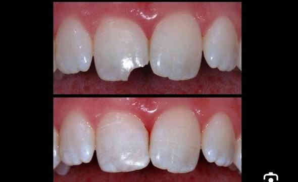 اللي عنده هيج تسوس يراسلني خاص العلاج مجاني ***********
