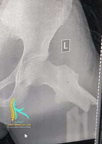 تثبيت كسر معقد • الشامية • عيادة حيدر