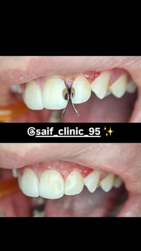 حشوة تجميلية • كربلاء • حي المدراء