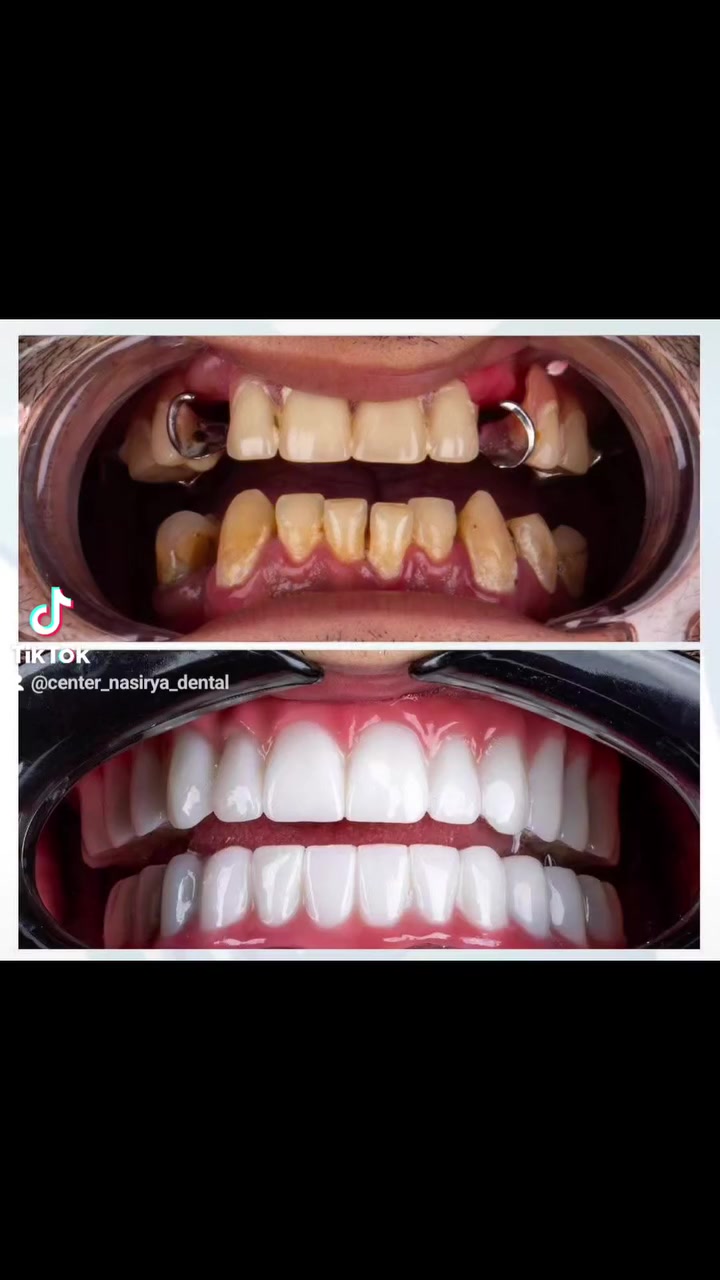 مو بس تجميل، احنا نبنيلك أبتسامة جميلة . ✔️أطباء محترفين ،✔️ أجهزة متطورة،✔️ نظافة عالية الجودة ،✔️ ومواعيدك دقيقة. 
وياهم ضمان وتقسيط مريح بلا فوائد.

متواجدين لخدمتكم طيلة أيام الأسبوع 

#صحة_فم_وأسنان #زراعة_اسنان_باسعار_مناسبة #صحة_الأسنان #ابتسامة_هوليود  #مراكز_الشركة_الطبية_العالمية

العنوان /الناصرية /المنصورية /بين الاطفاء وخطوة الامام علي (عليه السلام)
للحجز والأستفسار 
***********
***********
***********
وللاستفسار عن تراكيب الأسنان الثابتة والمتحركة
يرجى الأتصال على رقم المختبر
0781 310 8820

نظام الحجز مفتوح 
ودوام المركز طيله ايام الاسبوع 
الشفت الصباحي من ٨  لل ١ الظهر
الشفت المسائي  من  ٣ ل  ١٠ المسا
