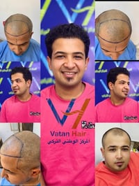 زراعة الشعر • المنصور بغداد • ضمان مدى الحياة
